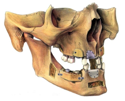 Abb. 1.: Verschiedene Möglichkeiten der Knochenentnahme und des Aufbaus im Ober- und Unterkiefer