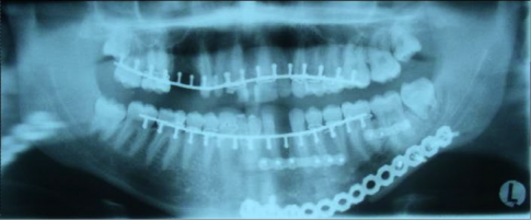 Abb.1 Röntgenbild nach einer Versorgung eines komplexen Unterkieferbruchs