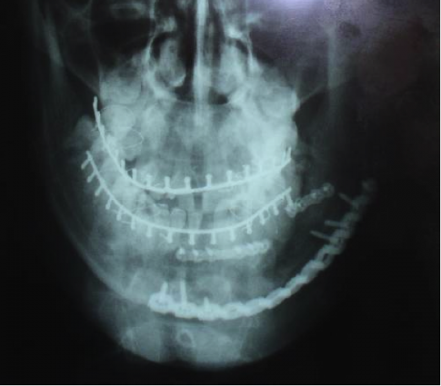 Abb.2 Röntgenbild nach einer Versorgung eines komplexen Unterkieferbruchs