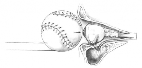 Augenhöhlenbruch durch einen Ball