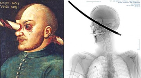 Abb. 1 historisches Bild einer Pfählunsverletzung, links: Impaled Head. The Lancet 375:317, 2010