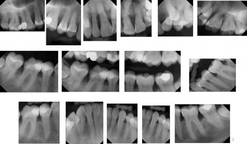 Abb. 2 Röntgenuntersuchung zur Beurteilung einer Parodontitis