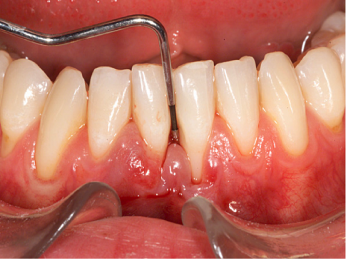 Abb. 1 Sondierung der Zahnfleischtasche