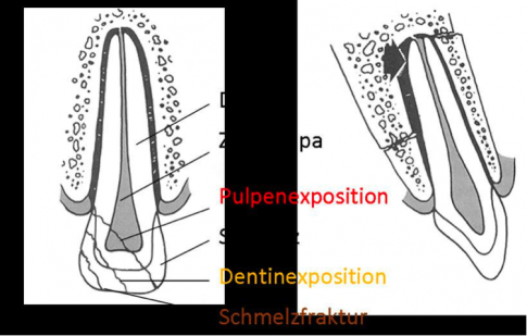 Zahntrauma